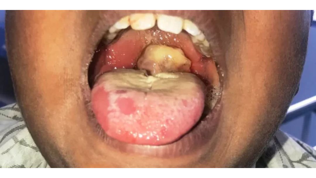 Featured image: Diphtheria outbreak claims 10 children in Niger