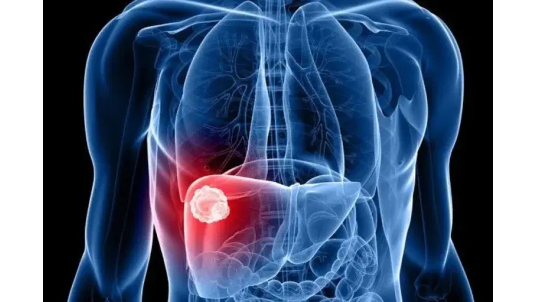 Featured image:  Liver Cancer Expected to Double Worldwide, Despite Largely Preventable Causes