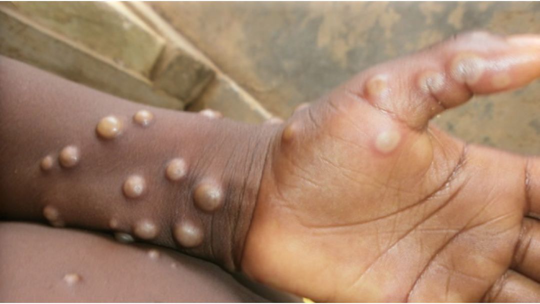 Featured image: Obodo Kaduna Ga-amalite Ịgba Mgbochi Mpox N’ime Ụmụ mpaghara E metụtara ọrịa ahụ"